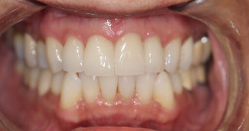 Heninger Dental: Dr Cam Heninger in Orem Teeth 1 After