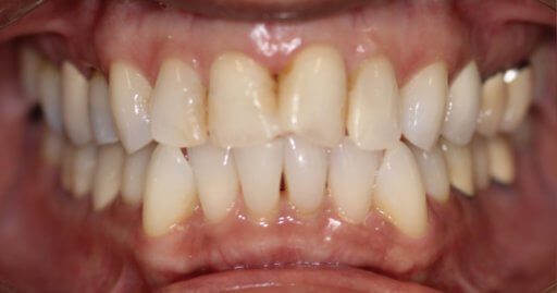Heninger Dental: Dr Cam Heninger in Orem Teeth 1 Before