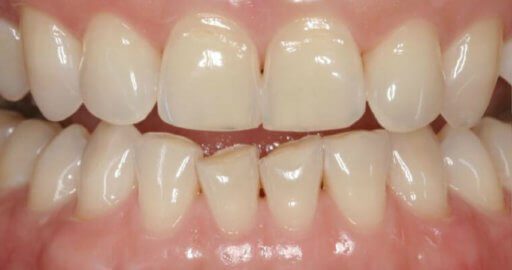 Heninger Dental: Dr Cam Heninger in Orem Teeth 3 Before