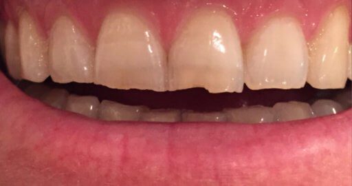 Heninger Dental: Dr Cam Heninger in Orem Teeth 5 Before