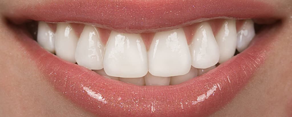 Heninger Dental: Dr Cam Heninger in Orem Veneers 11 1024x410 1