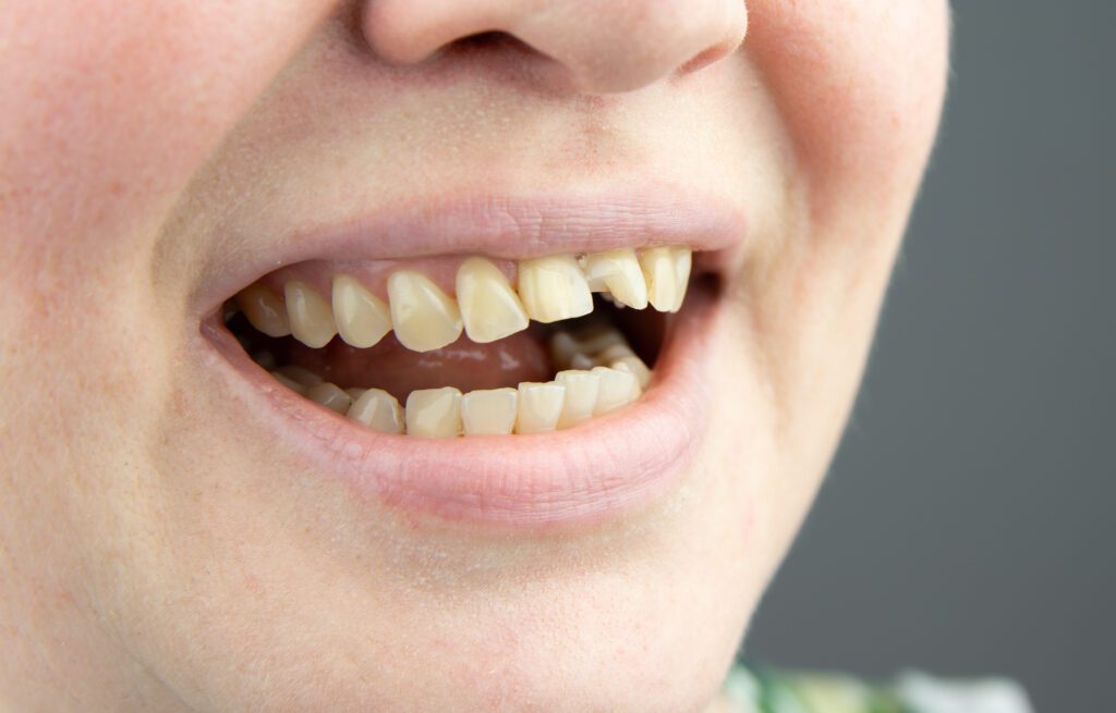 Heninger Dental: Dr Cam Heninger in Orem cracked teeth 2
