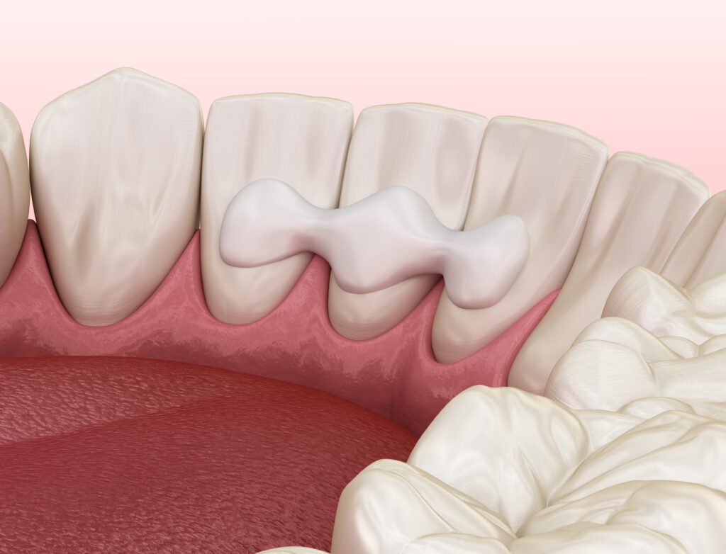 Heninger Dental: Dr Cam Heninger in Orem dental bonding 3