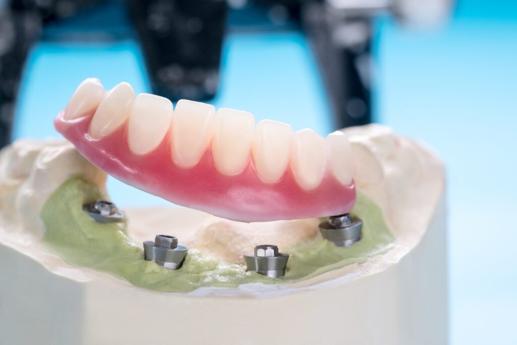 Heninger Dental: Dr Cam Heninger in Orem implant retained partials