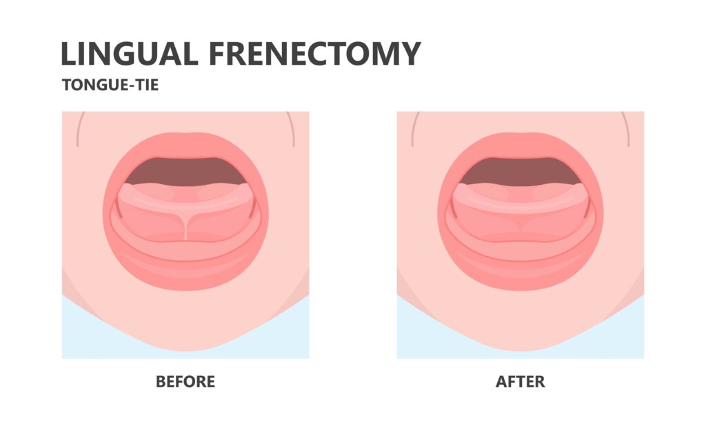 Heninger Dental: Dr Cam Heninger in Orem lingual frenectomy