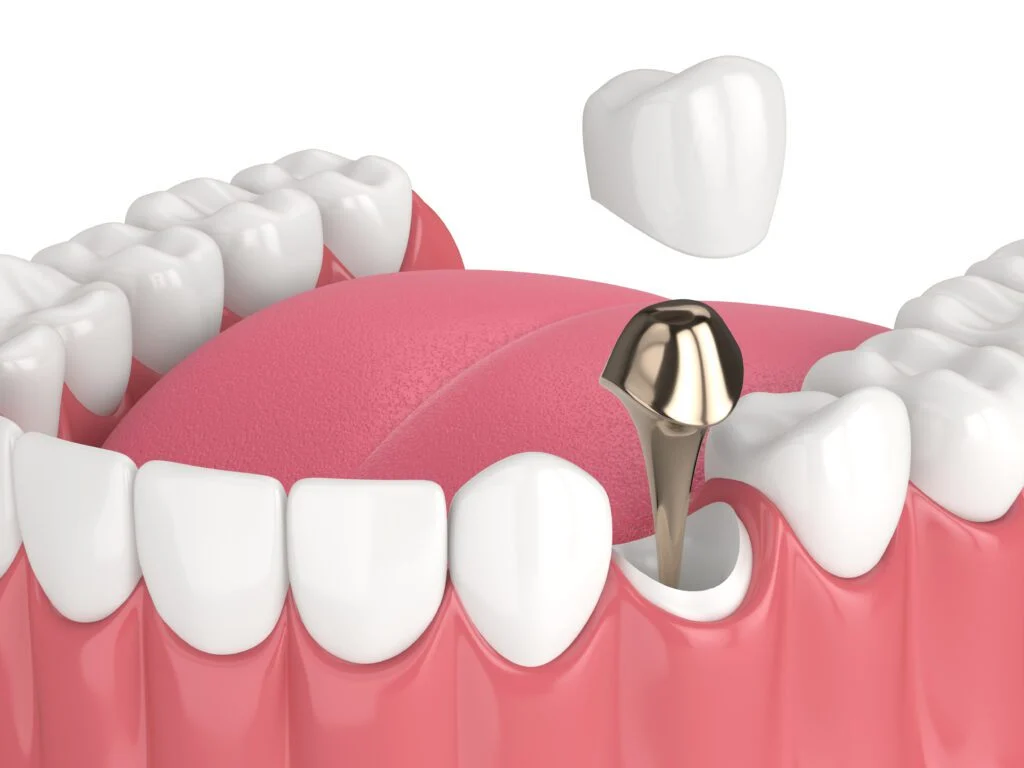 Heninger Dental: Dr Cam Heninger in Orem post and core